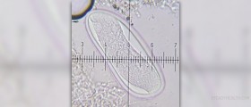 Treatmetn for wart on face