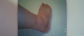 Twisted ankle facts