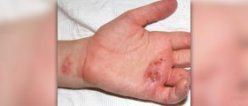 Types of eczema treatment