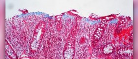 Ulcerative colitis complications