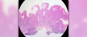 Ulcerative colitis treatment