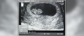 Ultrasound imaging for endometrial hyperplasia