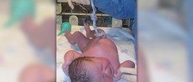 Umbilical cord around neck at birth