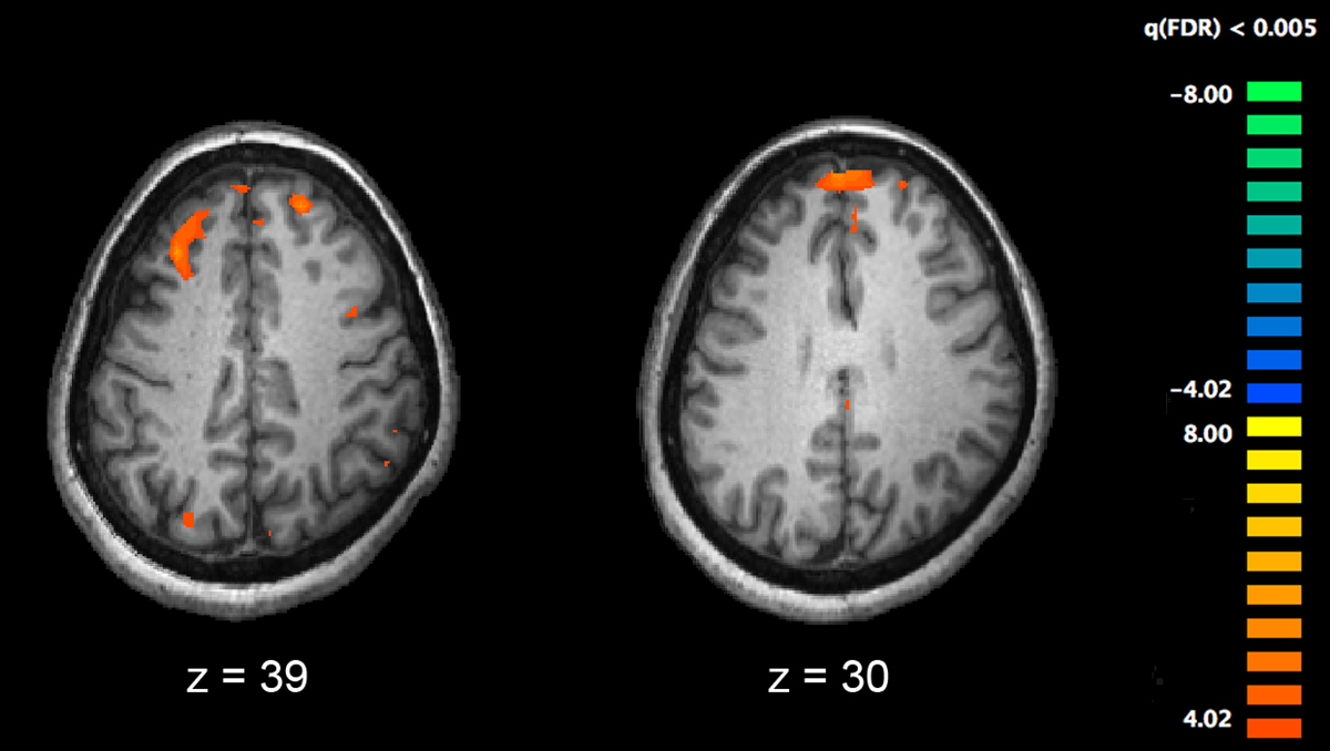 auditory hallucinations schizophrenia