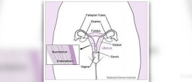 Uterine ablation facts