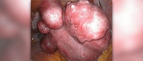 Uterine fibroid tumor - An essential truth for women