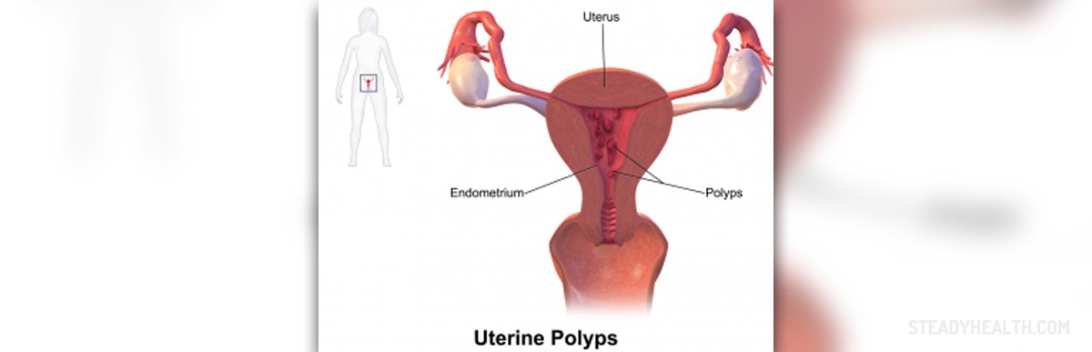 What Are Uterine Polyps Women S Health Articles