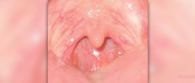 Uvula swelling review