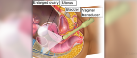 What is Ovarian Hyperstimulation Syndrome?