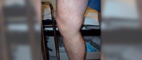 Varicose and spider veins
