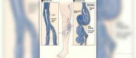 Varicose vein pain