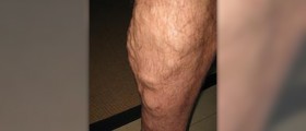 Varicose veins during pregnancy
