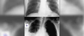 Viral pneumonia facts