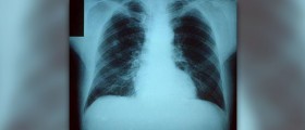 Viral pneumonia symptoms