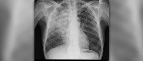 Walking pneumonia in children