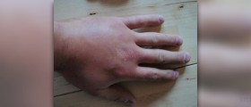 Wasp bite treatment
