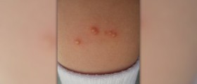 What are ant bites