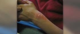 What are hives symptoms