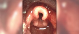 What are laryngitis causes