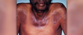 What are pellagra symptoms