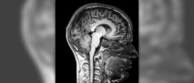 What are the benefits of MRI