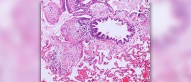 What are the pneumonia causes