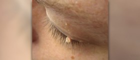 What are warts on face