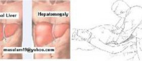 What causes an enlarged liver