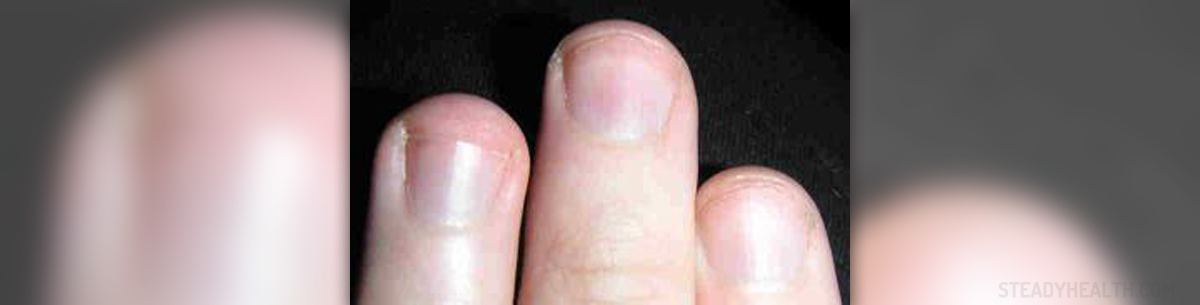 what-causes-fingernail-problems-general-center-steadyhealth