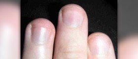 What causes fingernail problems