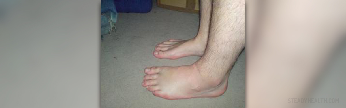 What causes swollen ankles General center