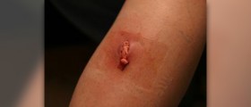 What is a staph infection