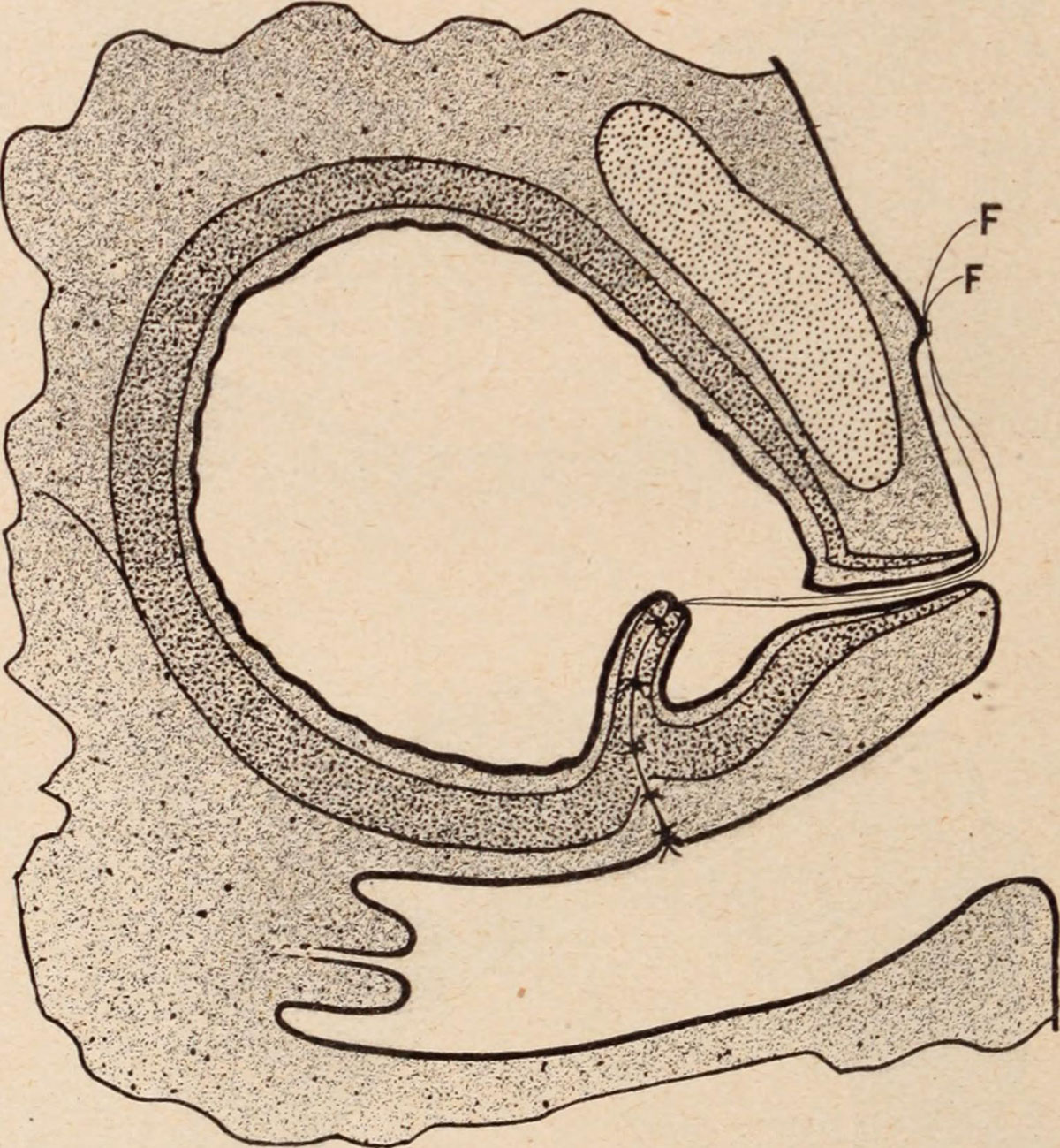 ic bladder