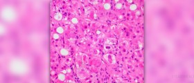 What is cirrhosis of the liver