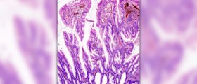 What is colonic inertia