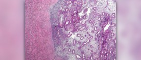 What is endometriosis