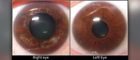 What is glaucoma