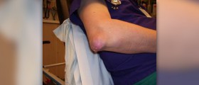 What is gout