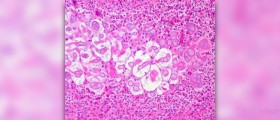 What is mycoplasma Infection
