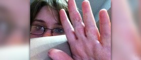 What is psoriasis disease?