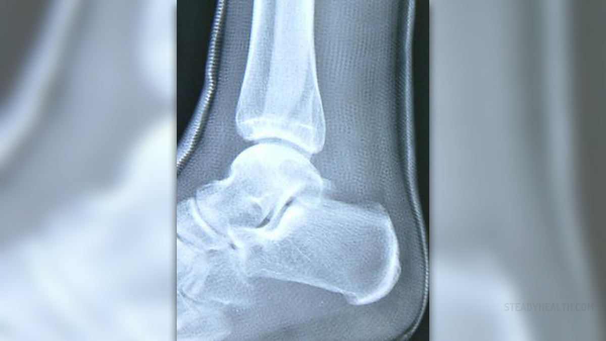 What is spiral fracture | General center | SteadyHealth.com