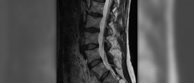 What is Tarlov cyst