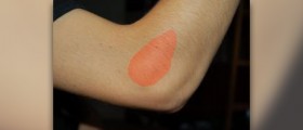 What is tennis elbow