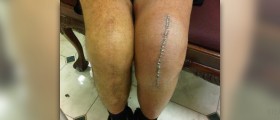 What is total knee replacement?