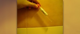 White blood cells in urine