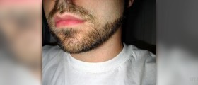 White spots on face
