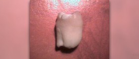 Wisdom teeth removal procedure