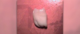 Wisdom tooth dry socket