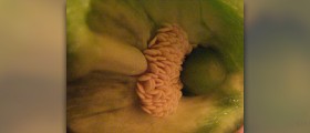 What if you have an incompetent cervix during pregnancy?