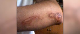Wound dehiscence facts